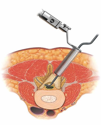 Decompression-Lumbar-Laminectomy